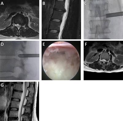 Treatment of Upper Lumbar Disc Herniation with a Transforaminal Endoscopic Technique